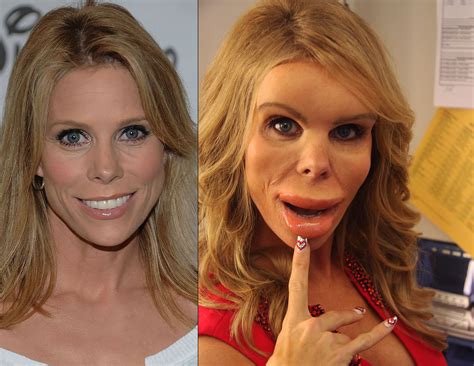 botox gone wrong pics